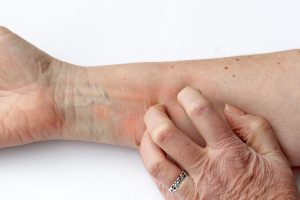 Itching reddened skin